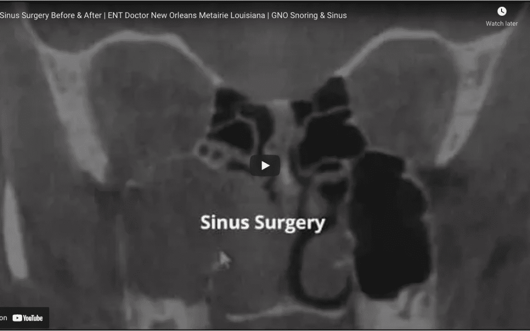 Sinus Surgery Before & After