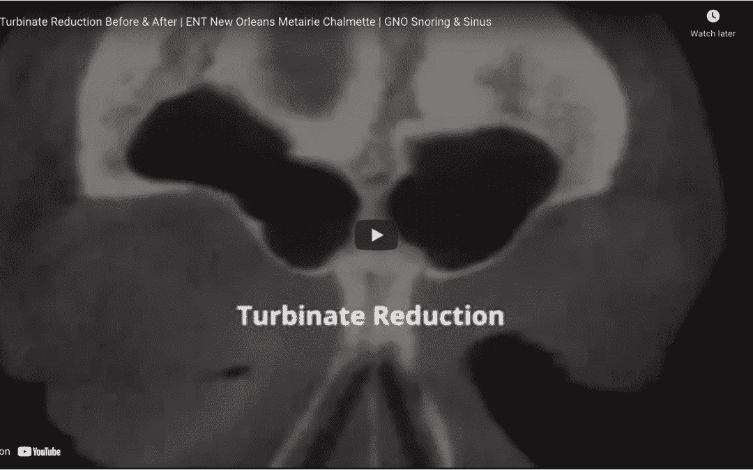 Turbinate Reduction Before & After