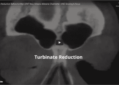 Turbinate Reduction Before & After