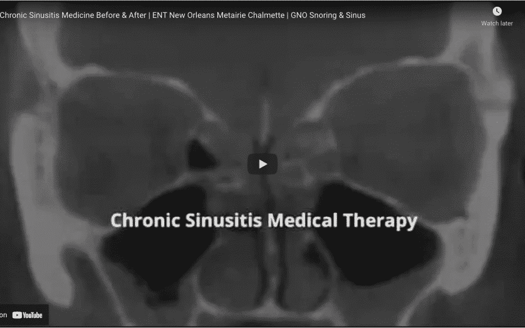 Before & After: Chronic Sinusitis Medical Therapy at GNO Snoring & Sinus